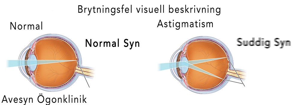 Operation för att korrigera brytningsfel i ögonen