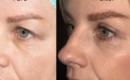 Före- och efterbild av kvinna som gjort övre ögonlocksplastik på Avesyn Ögonklinik