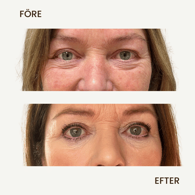 “Före- och efterbild på patient med resultat efter övre ögonlocksplastik, med tydligt piggare och slätare övre ögonlock.