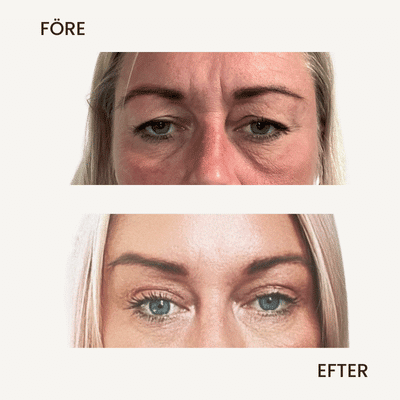 Före- och efterbild på resultat av övre ögonlocksplastik som reducerar hudveck och ger en mer definierad och upplyft ögonform.