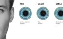 Illustration som visar skillnaden mellan PRK, FS-LASIK och SMILE vid ögonlaserbehandling.
