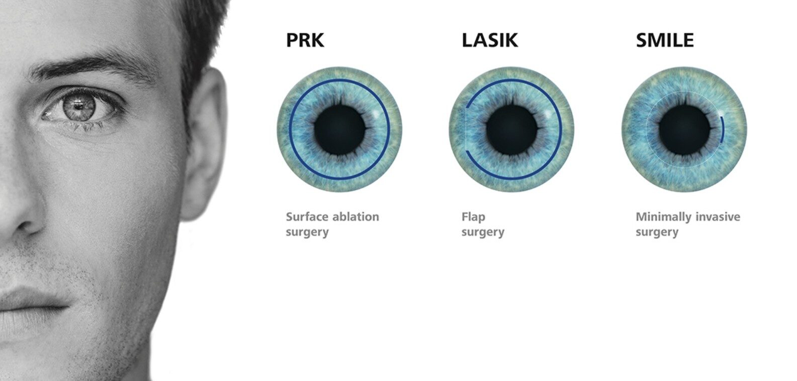Illustration som visar skillnaden mellan PRK, FS-LASIK och SMILE vid ögonlaserbehandling.