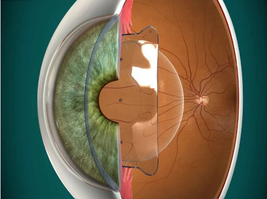 ICL-lins placerad i ögat för synkorrigering av närsynthet, översynthet och astigmatism